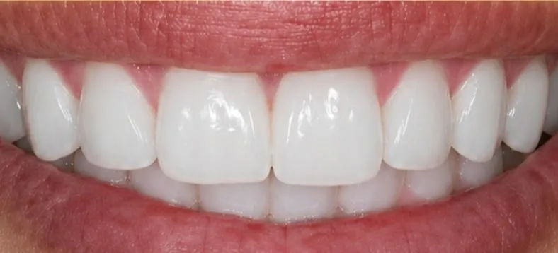 Royal Dental Center case 1, the same patient's teeth after treatment.