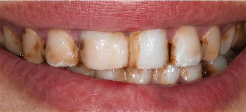 Royal Dental Center case 1, a patient's teeth before treatment.