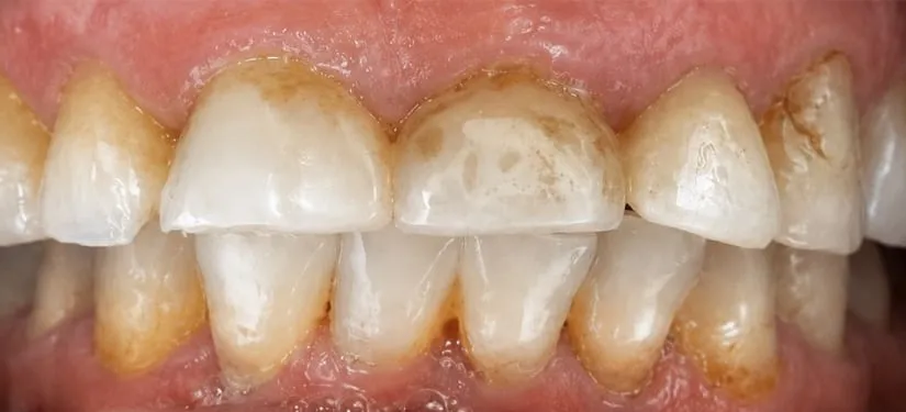 Royal Dental Center case 2, a patient's teeth before treatment.