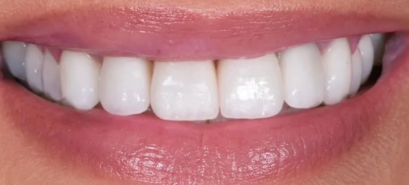 Royal Dental Center case 3, the same patient's teeth after treatment.