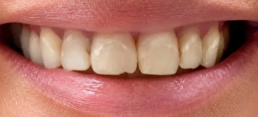 Royal Dental Center case 3, a patient's teeth before treatment.