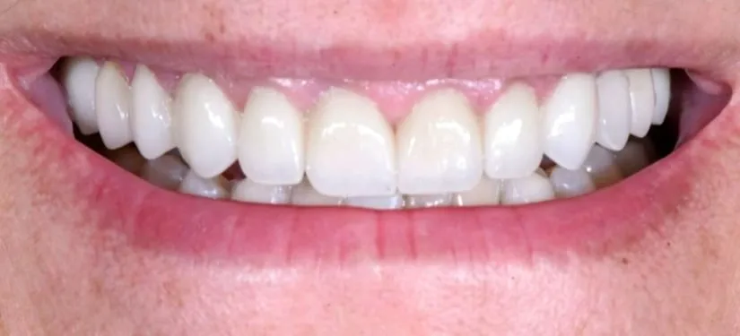 Royal Dental Center case 4, the same patient's teeth after treatment.
