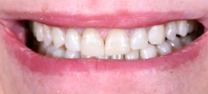 Royal Dental Center case 4, a patient's teeth before treatment.