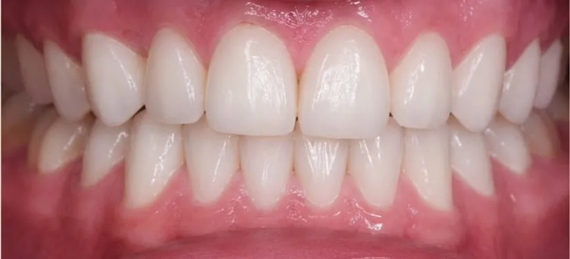 Royal Dental Center case 5, the same patient's teeth after treatment.