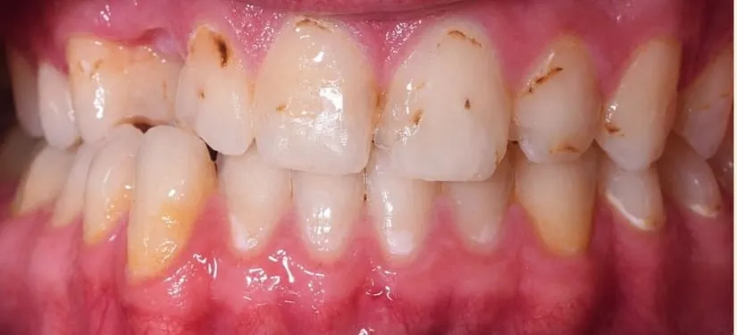 Royal Dental Center case 5, a patient's teeth before treatment.