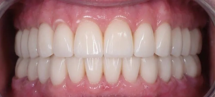 Royal Dental Center case 7, the same patient's teeth after treatment.