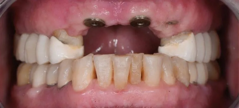 Royal Dental Center case 7, a patient's teeth before treatment.