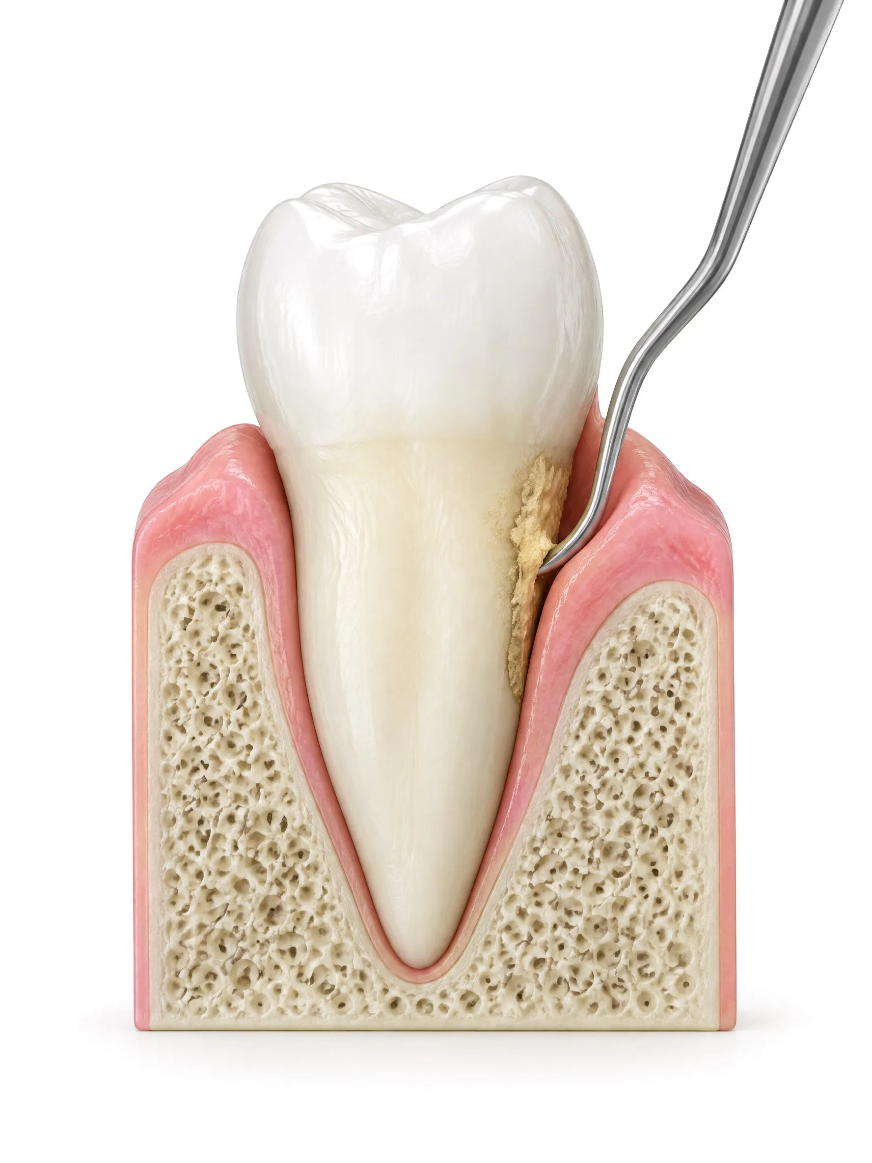 Cross section of a tooth with a cleaning instrument lifting tartar off the root below the gum line.