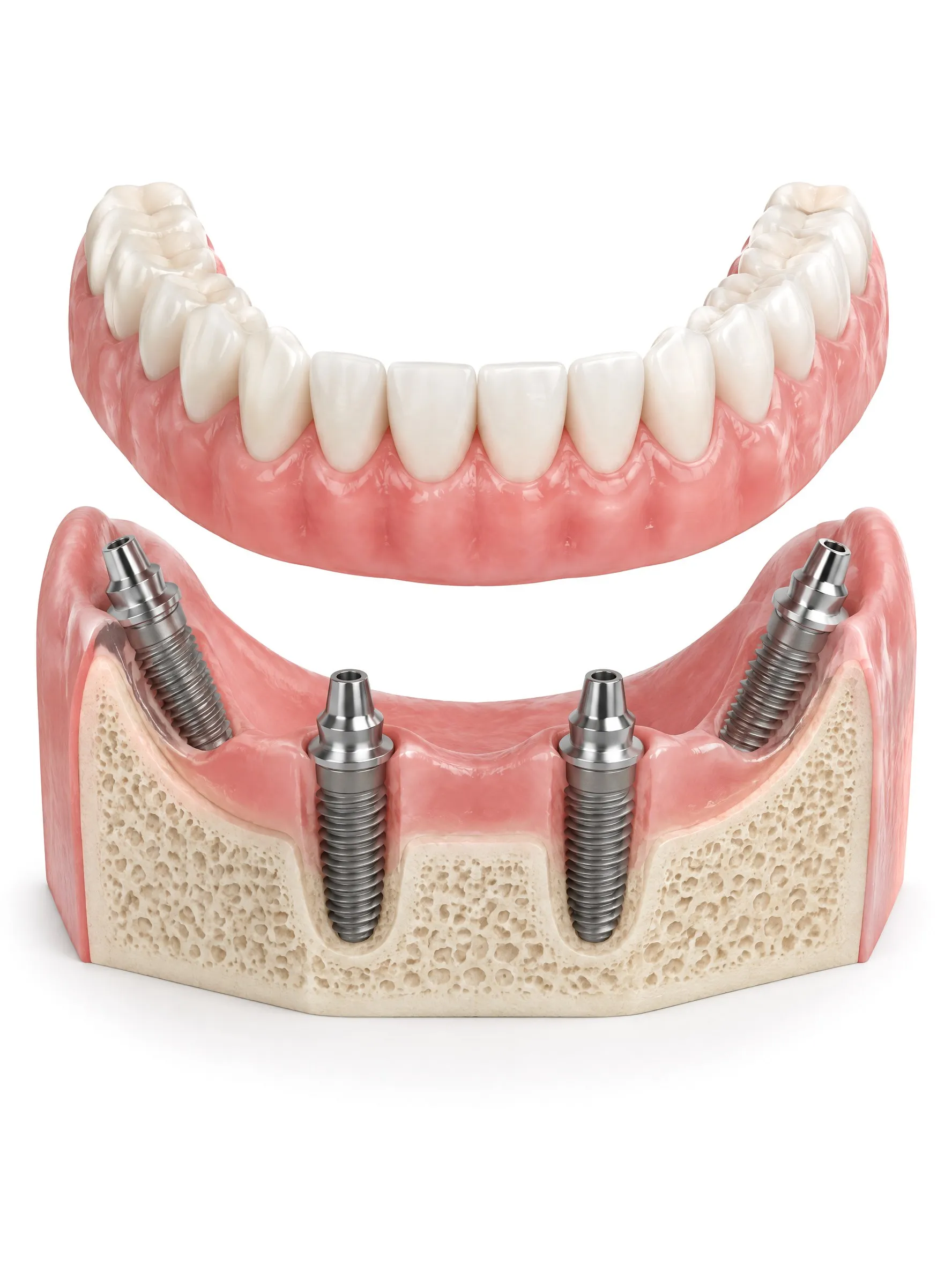 Illustration of a lower jaw with four dental implants and a full arch of teeth about to be fixed onto them.