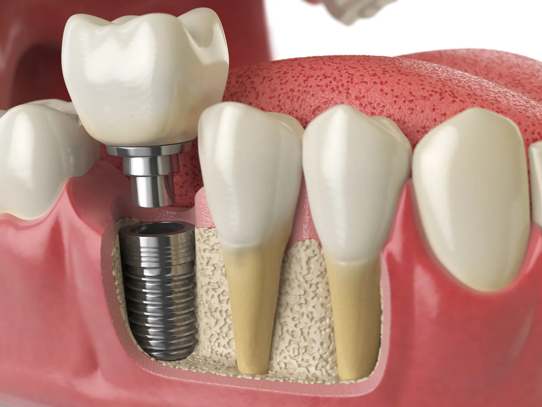 A model of a dental implant in the jaw, shown in cross section beside natural teeth
