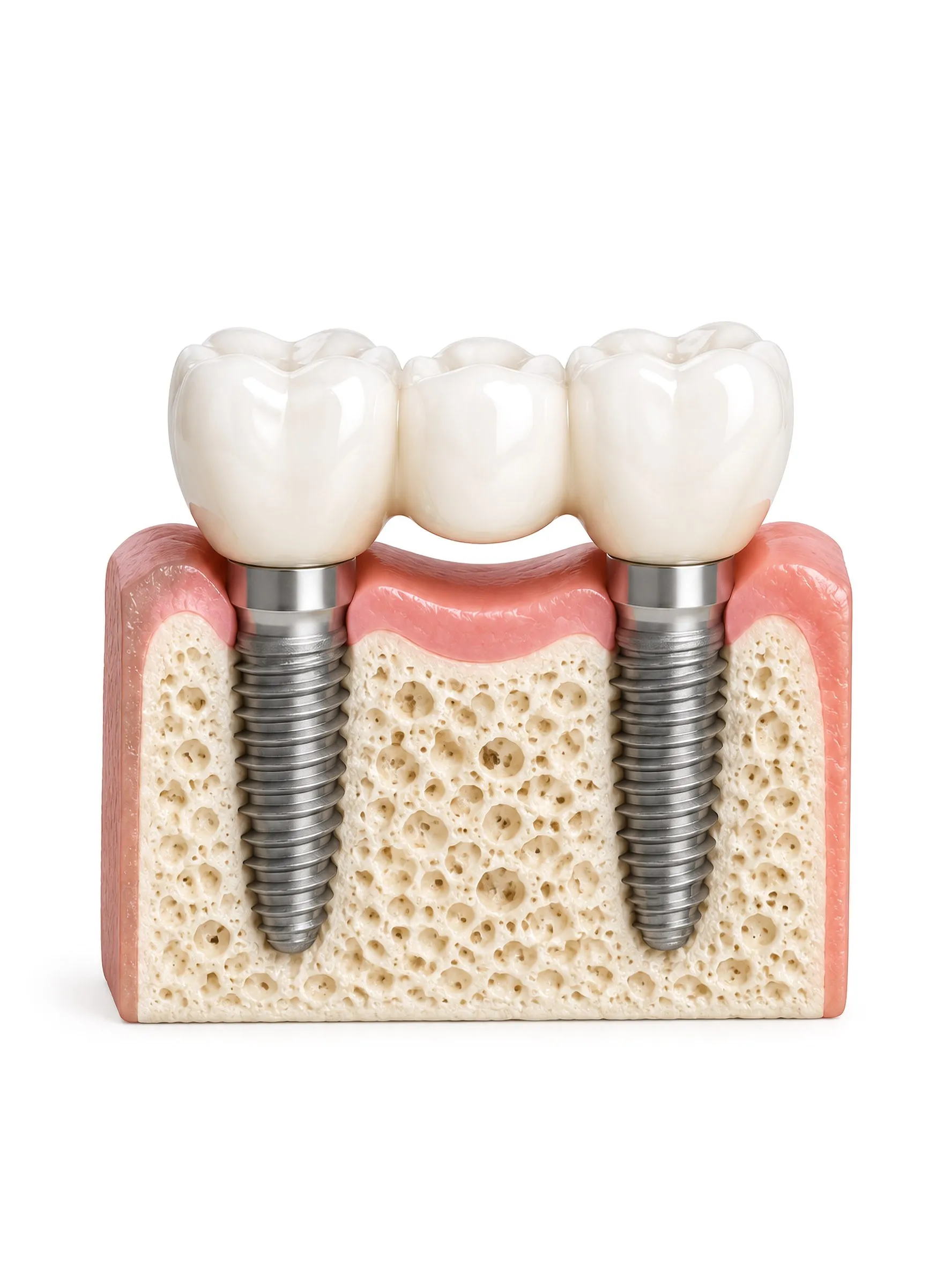 Cross section of the jaw with two dental implants supporting a three tooth bridge.