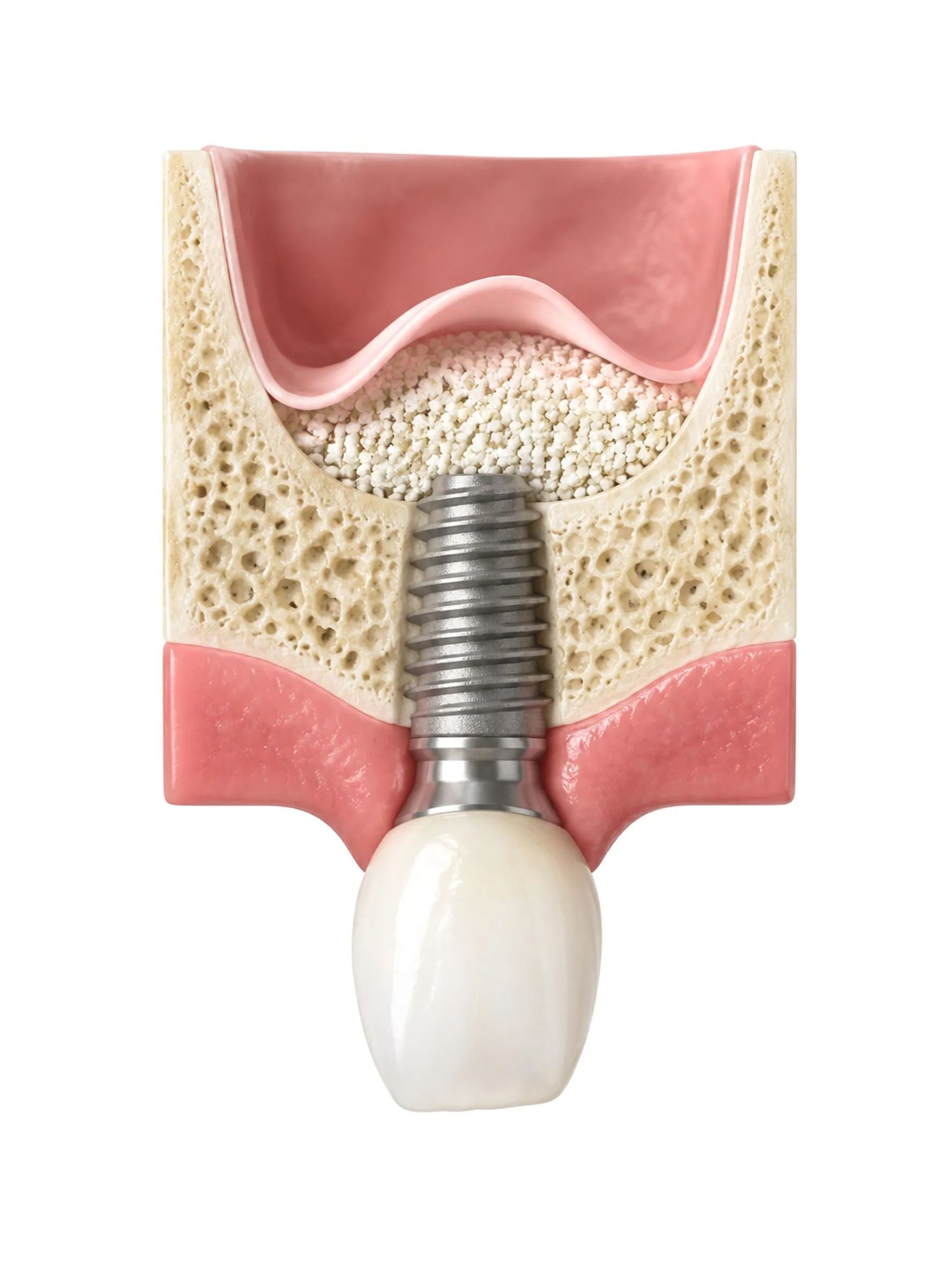Cross section of the upper jaw with the sinus lining lifted, graft material beneath it, and a dental implant in the new bone.