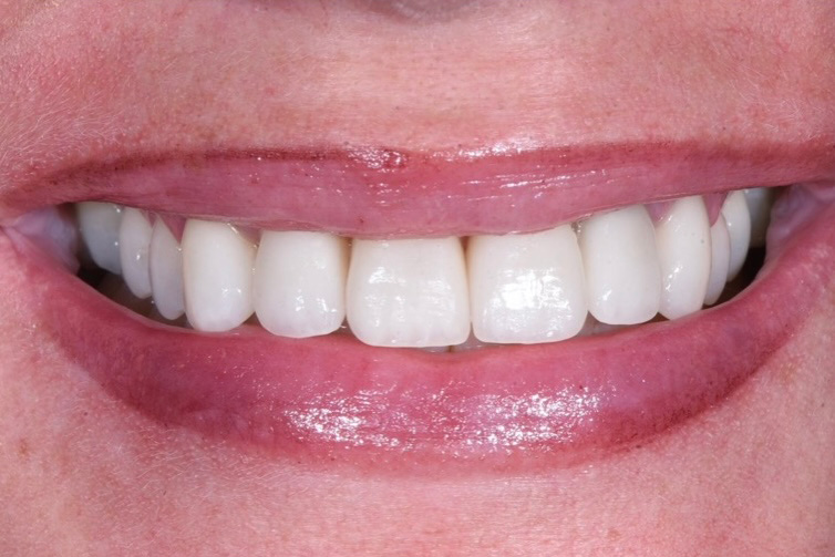 The image shows a close-up of a smiling person with white teeth and pink lips.