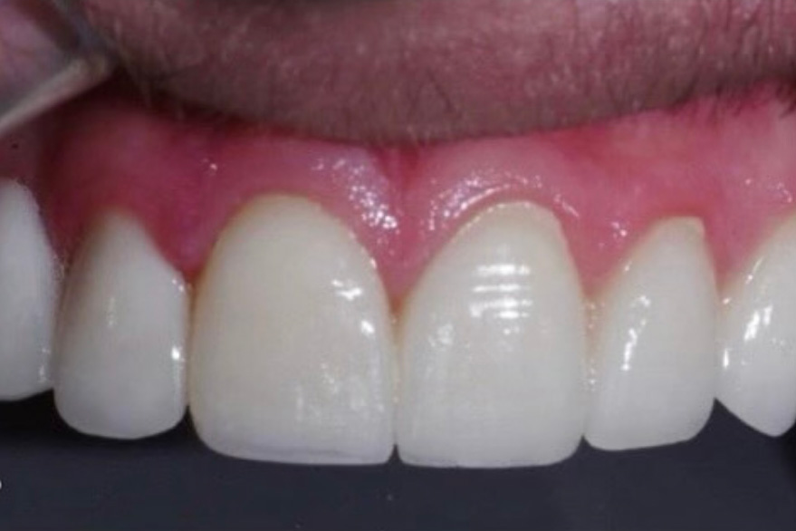 The image shows a close-up of a person s teeth with a red gumline, emphasizing a dental issue.