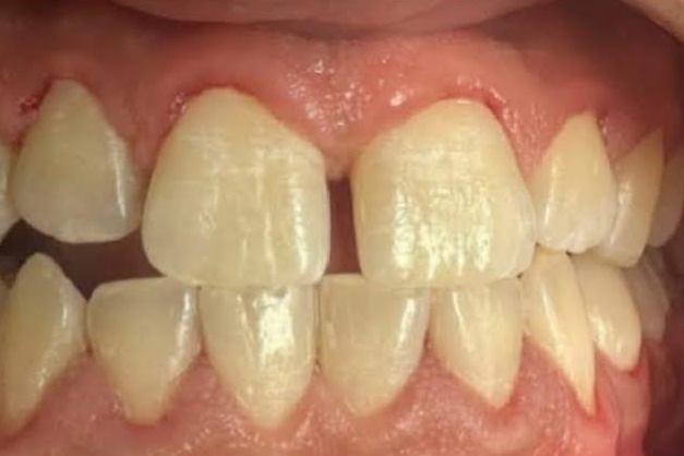 The image shows a close-up view of a person s teeth with visible signs of decay and damage, including yellowing and missing parts, against a red background.