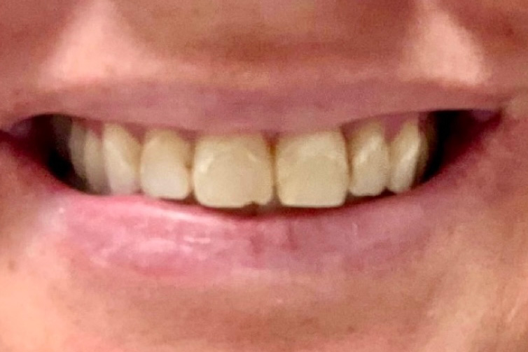 The image shows a person smiling at the camera with their teeth visible, and they appear to be wearing lipstick.