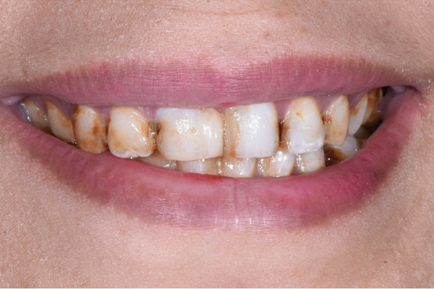 Royal Dental Center | Dentures, Teeth Whitening and Dental Cleanings