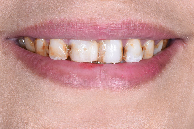 Royal Dental Center | Veneers, Invisalign reg  and ZOOM  Whitening