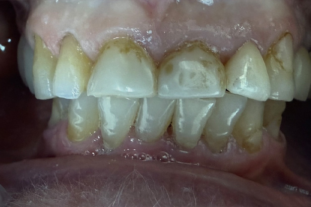 Royal Dental Center | Fluoride Treatment, Implant Restorations and Invisalign reg 