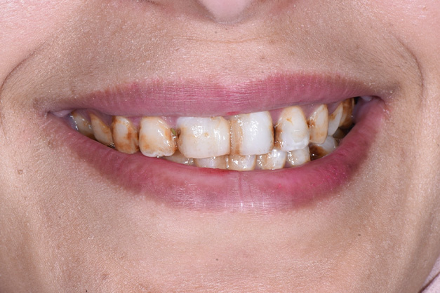 Royal Dental Center | Advanced Dental Technology, Dentures and ZOOM  Whitening