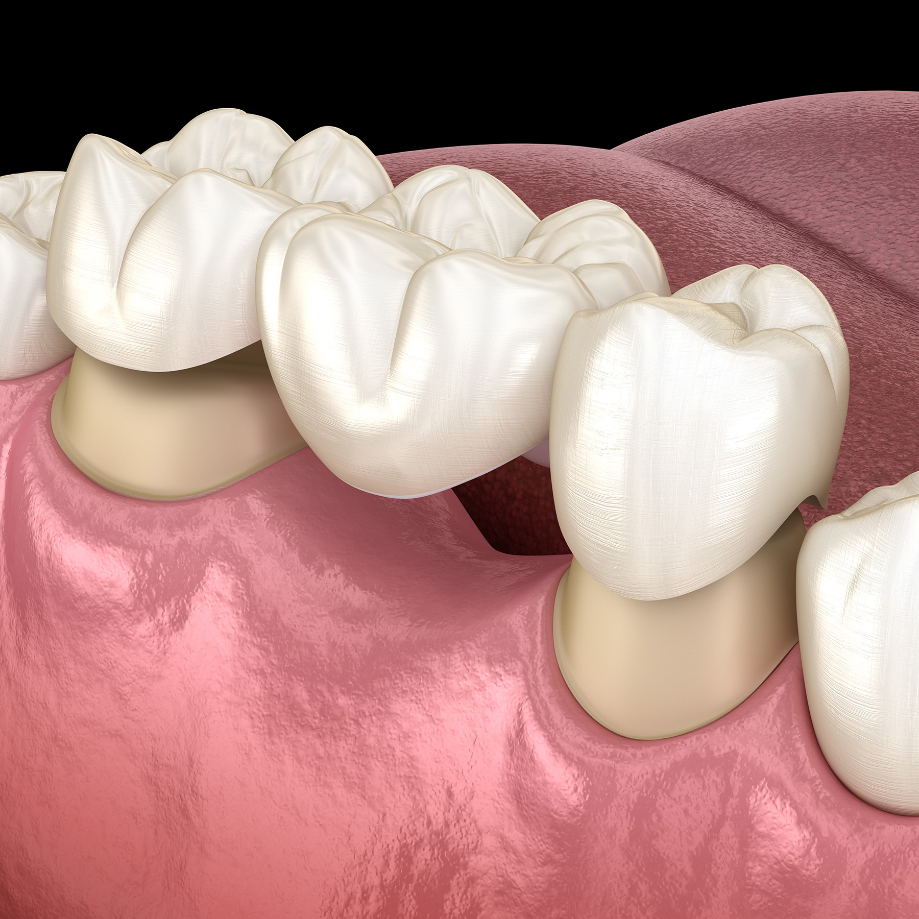The image shows a close-up view of an upper dental arch with natural teeth, including incisors, canines, premolars, and molars, against a black background, with two different perspectives side by side.