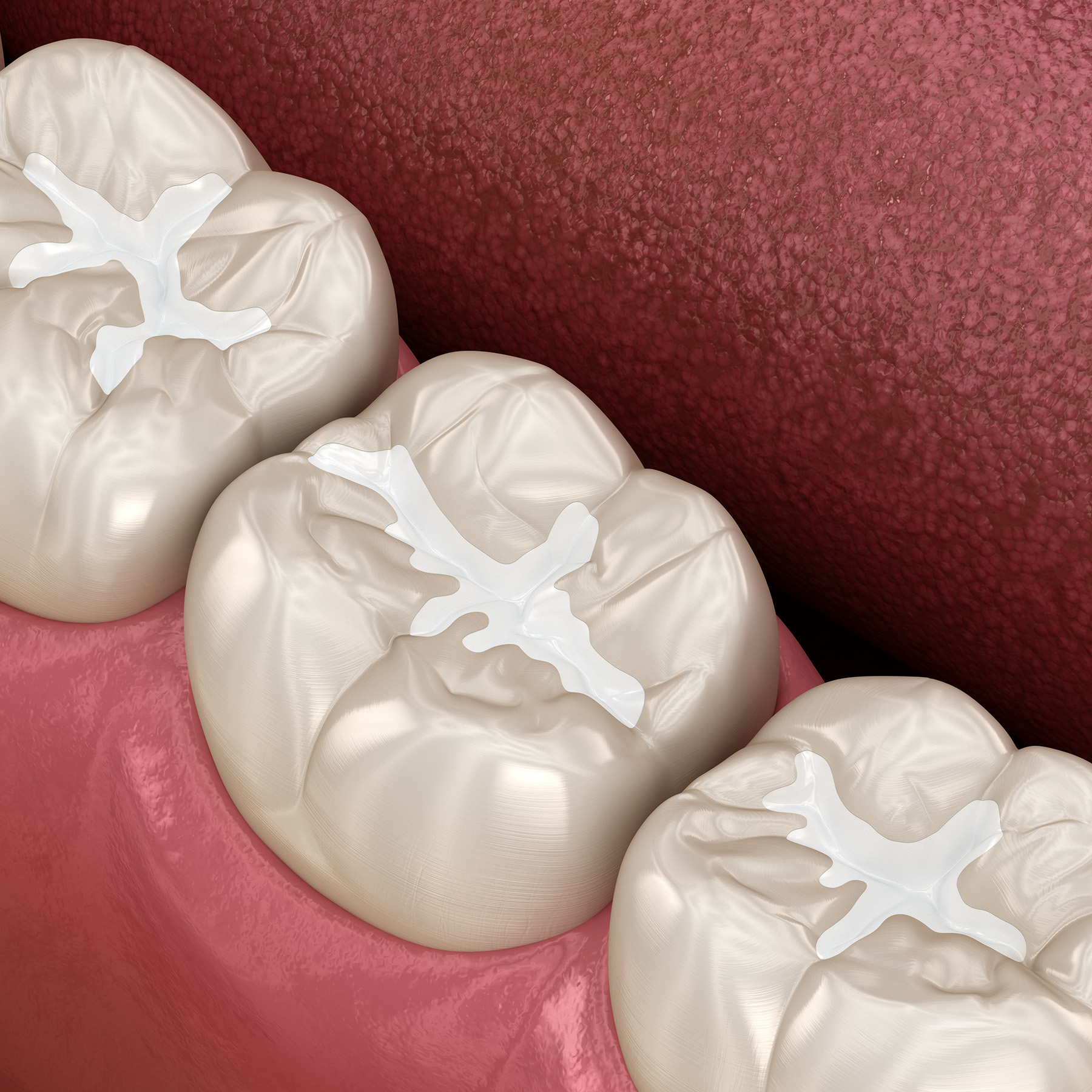 Alt text   Digital illustration of a set of upper dentures with a realistic tooth texture, featuring a prominent central incisor and two canine teeth with a white filling design.