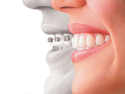 The image features a split-screen comparison of a person s natural teeth with their teeth after dental treatment, highlighting the transformation achieved through orthodontic care.