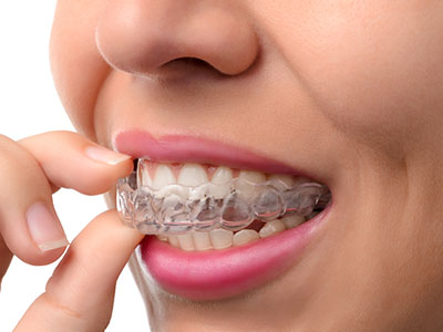 The image shows a person with a visible orthodontic appliance, likely an aligner, holding their teeth with one hand while wearing lipstick.