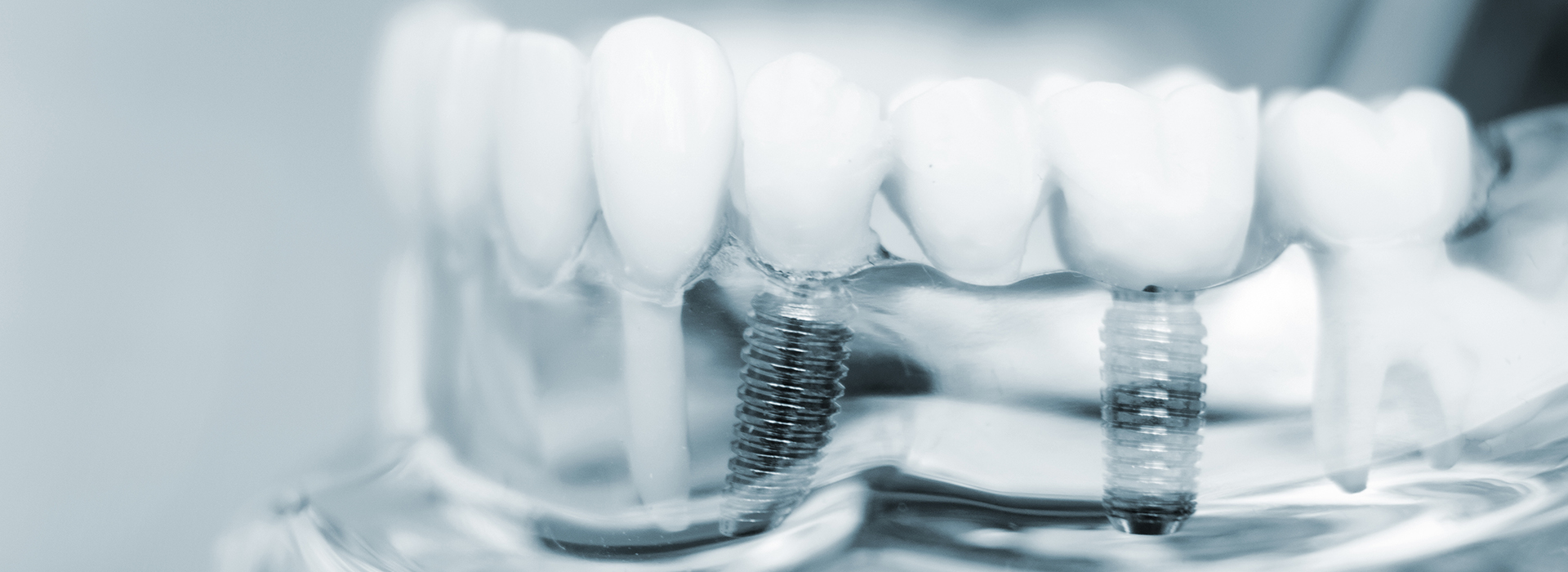 The image shows a close-up view of multiple toothbrushes with bristles, set against a blurred background that appears to be a collection of small objects or parts, possibly suggesting a theme related to dental care or hygiene.