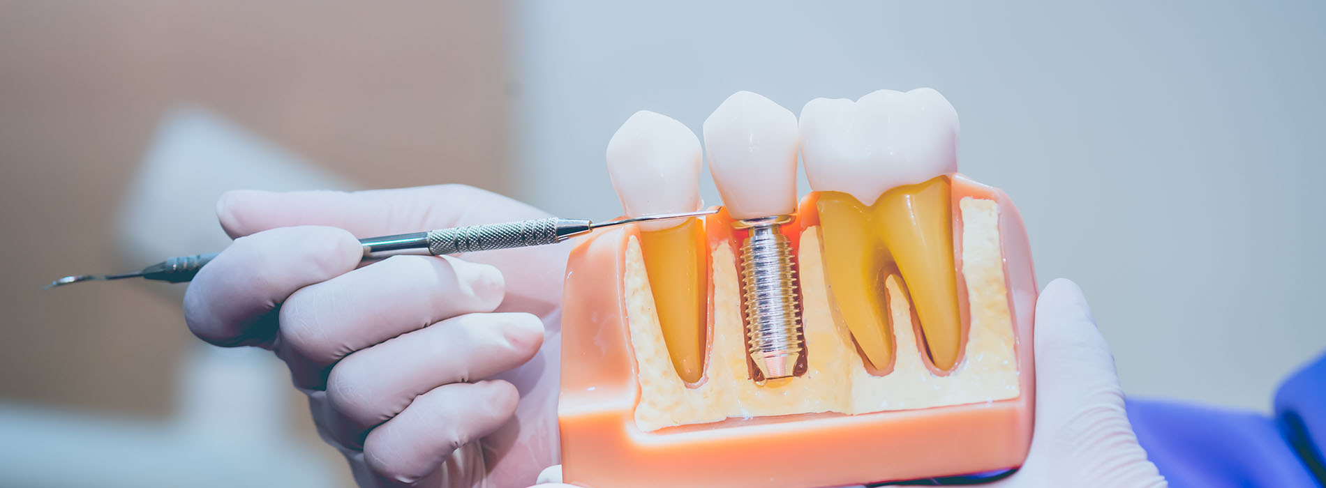 The image shows a dental professional using an instrument to manipulate a tooth with visible fillings, likely during a dental procedure.