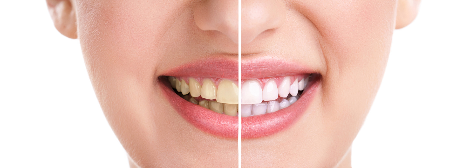 The image displays a close-up of a person s face with a focus on their teeth and mouth, showcasing a smile with white teeth and pink lips, set against a plain background.