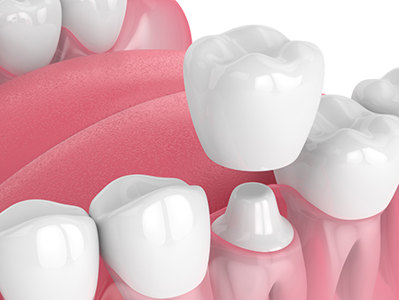 The image displays a close-up view of multiple teeth with a focus on their surfaces and gumline, presented against a pink background that resembles dental wax or a similar product.