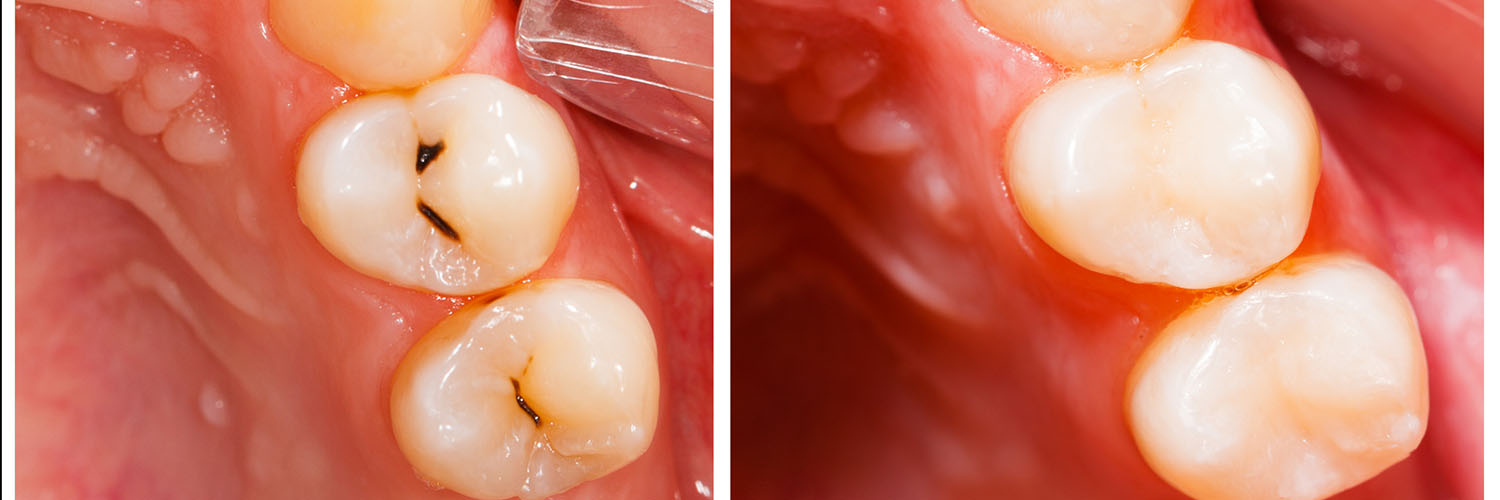 The image shows a close-up view of a mouth with a tooth that appears to have been recently extracted, featuring a large gap where the tooth was removed.