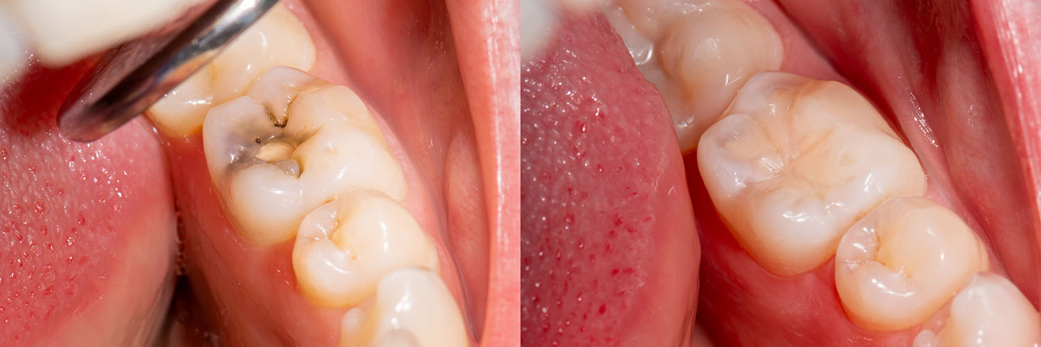 The image shows a close-up view of an open mouth with teeth, gums, and tongue visible, along with a dental implant in progress.