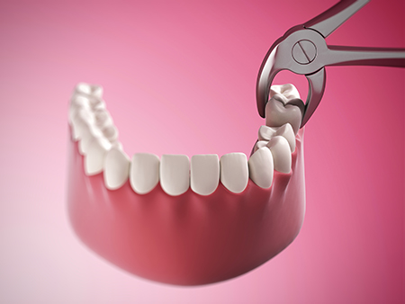 The image shows a close-up of a dental implant being inserted into a mouth with a pink interior, featuring a pair of pliers gripping the implant.
