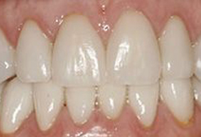 A close-up photo of a person s mouth showing a set of teeth with a focus on dental hygiene, likely for educational or promotional purposes.