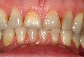The image shows two views of a person s mouth with severe tooth decay and discoloration, featuring yellowish-brown stains and missing enamel on the teeth, which appear to be in need of dental treatment.