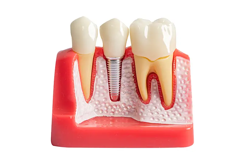 Dental Implants at Royal Dental Center